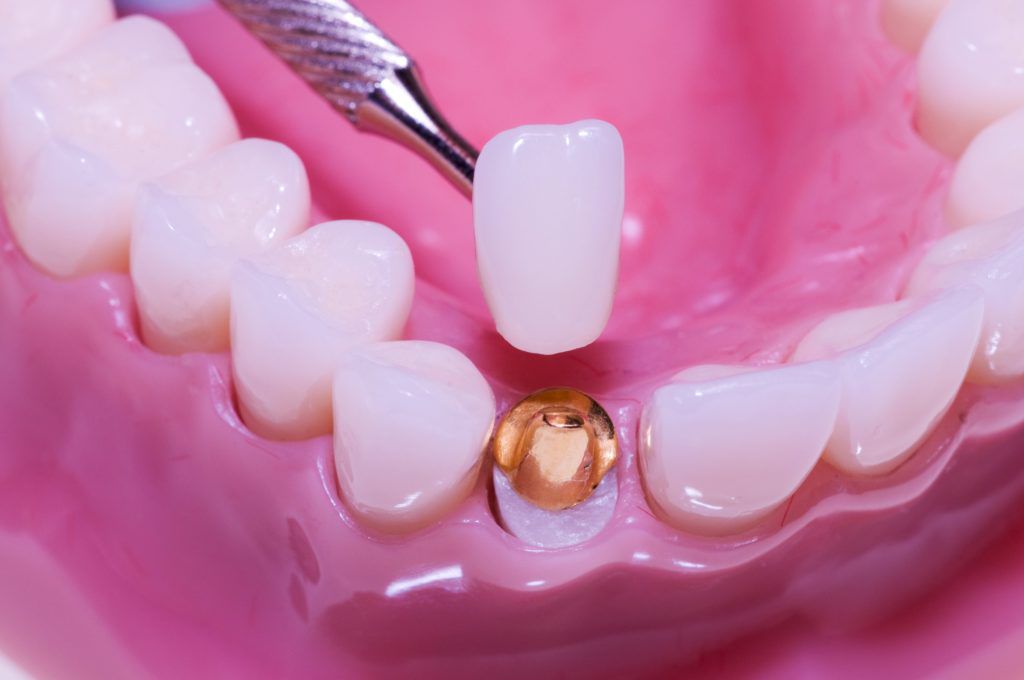 Porcelain Crowns A Great Way To Restore A Beautiful Smile Heritage