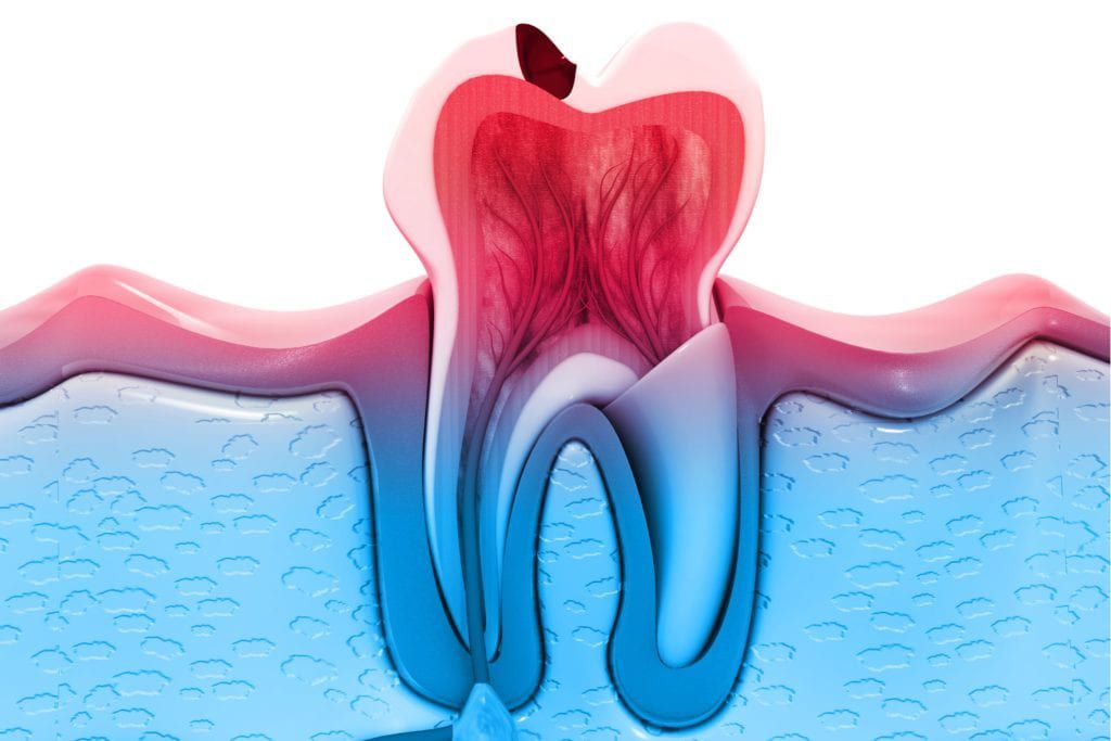 Dental model of a tooth with a cavity