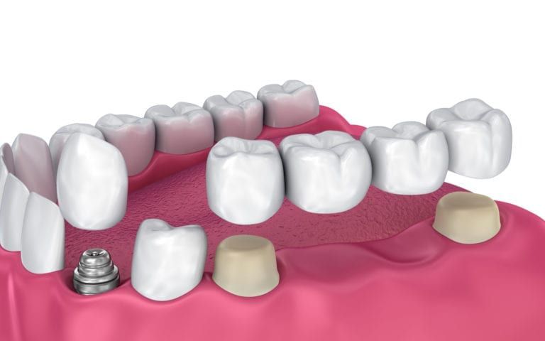 The Four Types of Dental Bridges - Heritage Park Dental- Dentist in ...