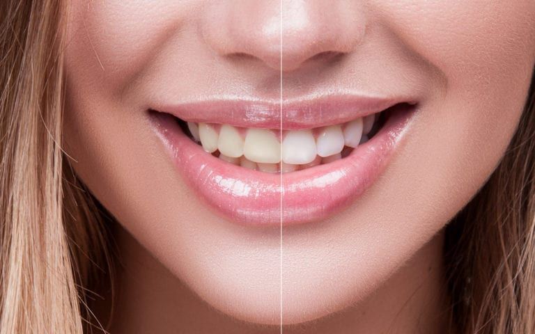 Woman Smiling showing teeth before and after whitening